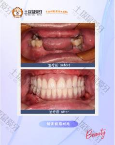 咀嚼功能异常，佩戴牙套治疗