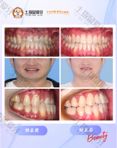 成人地包天+牙齿中线不齐矫治