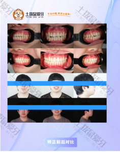 反颌，中线不齐矫正