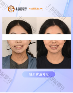 牙列不齐，嘴凸