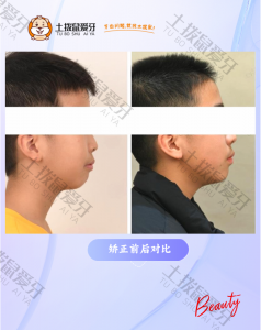 牙列不齐，龅牙