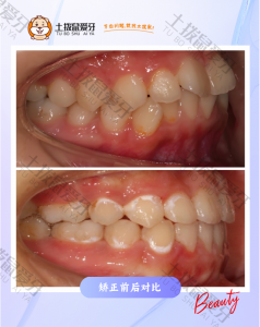 双颌前突，深覆合
