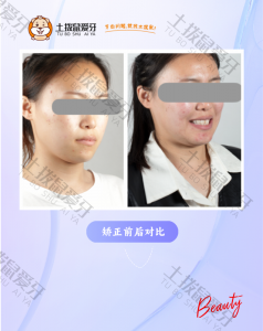 前牙拥挤，唇肌闭合紧张