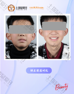 前牙拥挤、上颌骨发育不足
