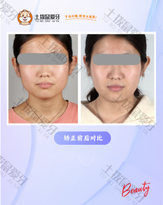 前牙前突，嘴突
