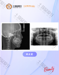 深覆合，笑线不佳中线不齐