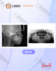 咬合不正，牙列不齐
