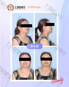 牙拥挤倾斜，咬合不正，唇线不正