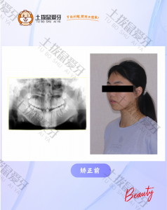 下巴后缩，牙拥挤错位