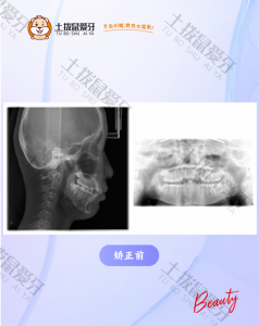 虎牙突出，牙排列不齐
