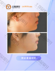 牙齿前突+深覆盖