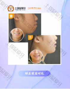 开颌+前突