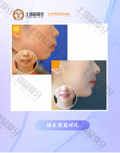 上颌前突，不齐