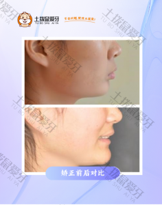 前牙前突+深覆合