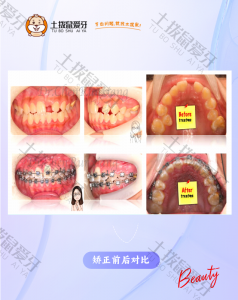 门牙倒置阻生 案例
