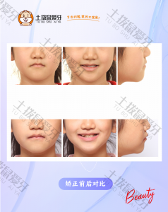 反颌，上中线左偏，上颌发育不足