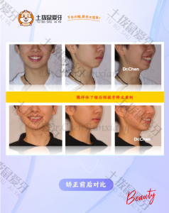 腺样体下颌后缩拔牙矫正案例