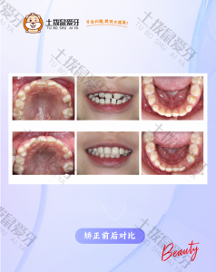 反颌，替牙期，口角左低右高