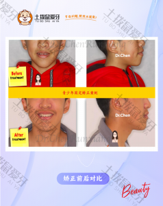 青少年嘴突不齐 地包天倾向