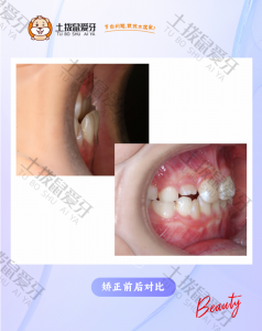 女童替牙期 反颌