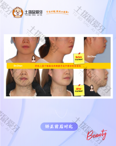 成人缺磨牙拉智齿案例