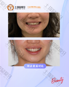 拥挤+深覆合深覆盖矫正