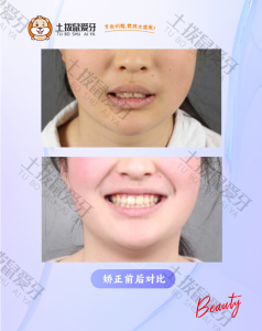 散隙+深覆合深覆盖