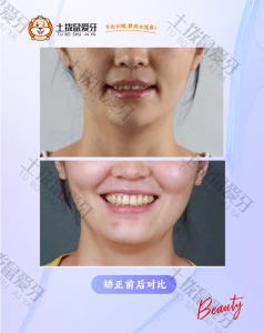 上下前牙拥挤+深覆盖矫正