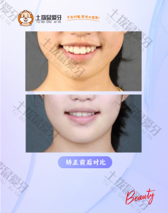 前牙深覆盖矫治