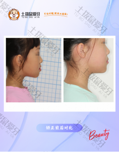 儿童地包天矫治