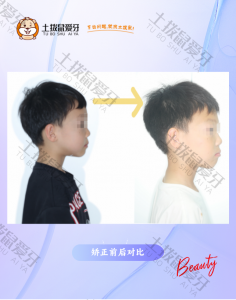 反颌 早矫