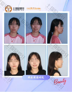 龅牙 上颌中切牙前突