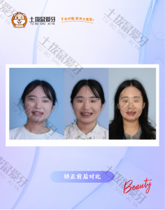 上下颌尖牙对刃 不齐