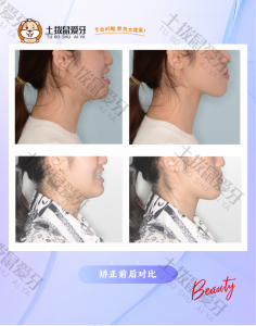 反颌骨扩 隐形