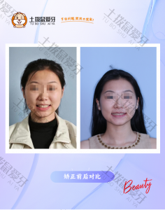 双颌前突 矫正