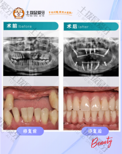 全口即拔即种即刻修复