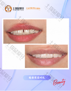 门牙 见2mm缝隙
