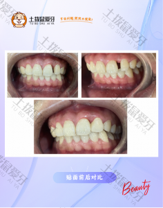 上前牙，间隙明显