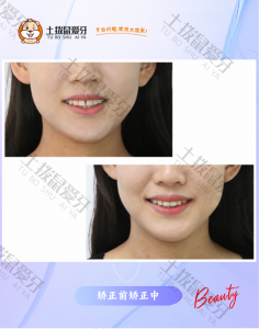开唇露齿，间隙大矫正中案例
