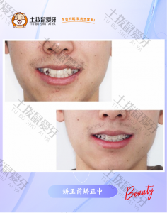 成人牙列不齐矫治案例