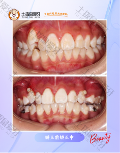 虎牙突出，上颌前突矫正中案例
