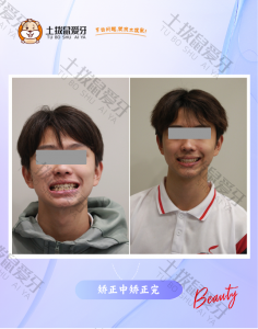 时代天使精调