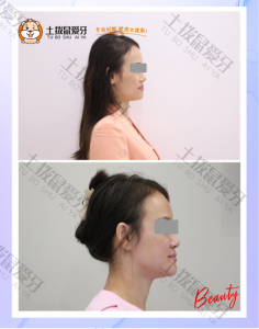 40+女士 反颌