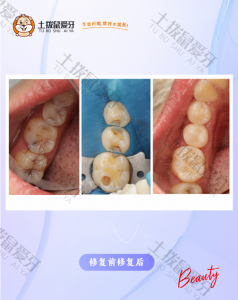 后牙多颗龋坏树脂充填
