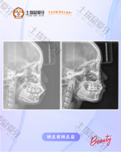 双颌前突矫正