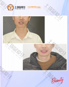 双颌前突矫正案例