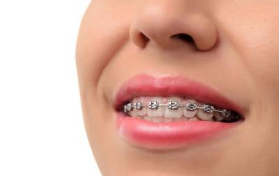 成人深覆合牙齿怎么矫正？补过的牙能正畸吗？