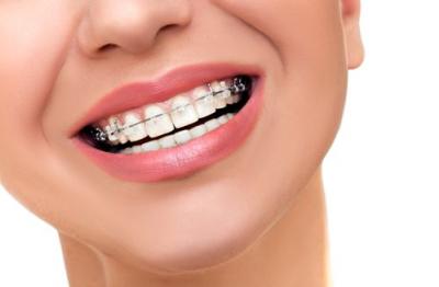 哺乳期可以去矫正牙齿吗？成人做牙齿矫正有哪些好处?