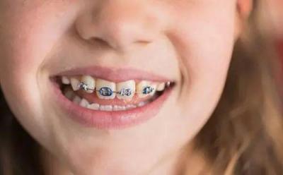 儿童适合哪种牙齿矫正方式？长歪的牙能矫正吗？