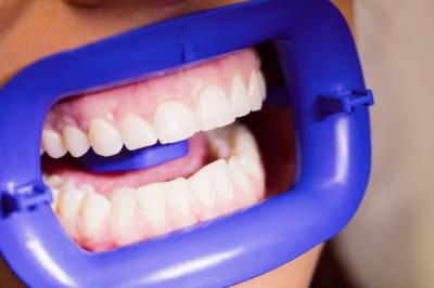 骨性牙齿矫正多少钱？传统牙套效果好还是隐形牙套效果好？